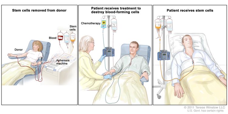 Stem cell transplant; (Panel 1): Drawing of stem cells being removed from a patient or donor. Blood is collected from a vein in the arm and flows through a machine that removes the stem cells; the remaining blood is returned to a vein in the other arm. (Panel 2): Drawing of a health care provider giving a patient treatment to kill blood-forming cells. Chemotherapy is given to the patient through a catheter in the chest. (Panel 3): Drawing of stem cells being given to the patient through a catheter in the chest.